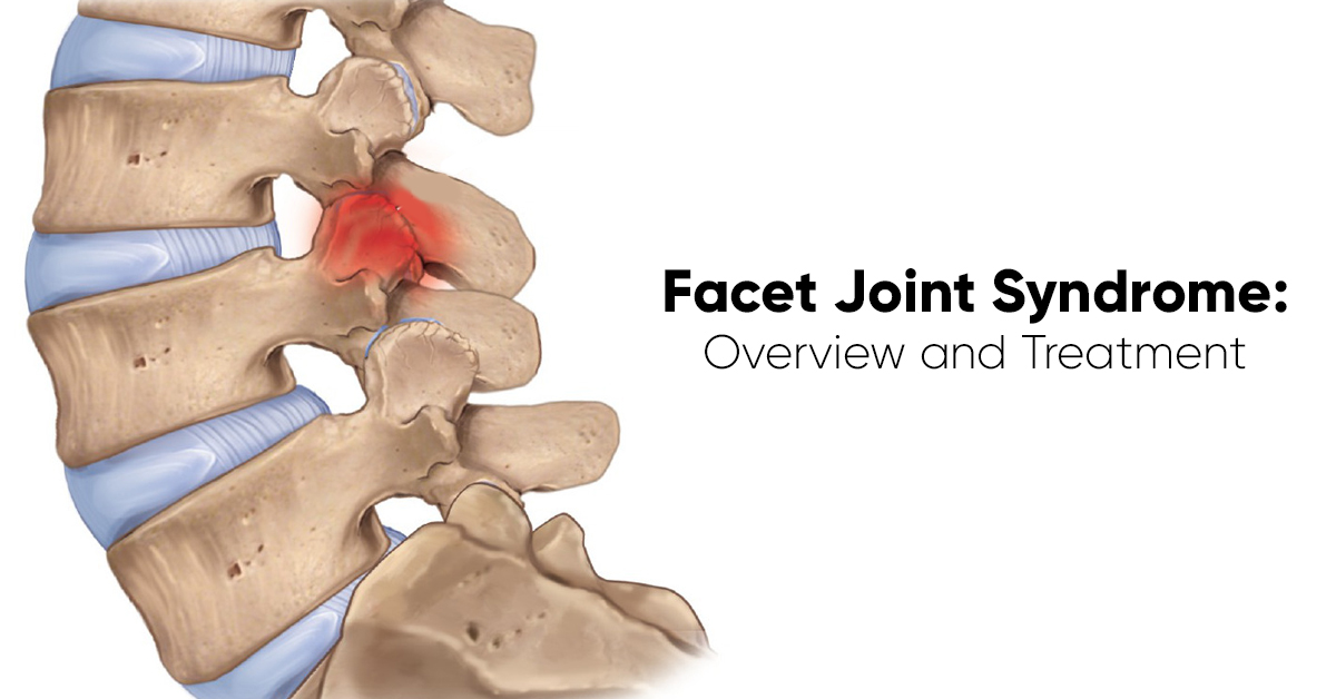 Facet Joint Syndrome: Overview and Treatment